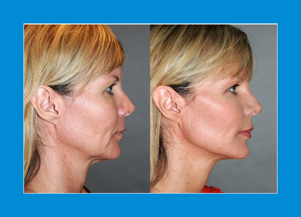 Before & after photos 90 days on from High intensity focused ultrasound Hifu showing jaw slackness lifted, nasio-labial lines lifted & crows feet reduction