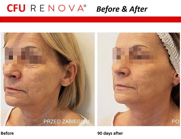 Before & after of facial skin lifting 90 days on from HIFU.