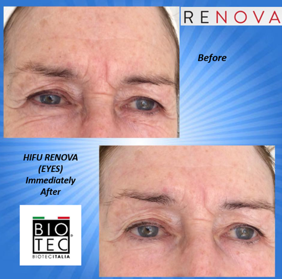 Before & after of High intensity focused ultrasound - Hifu on eye wrinkles